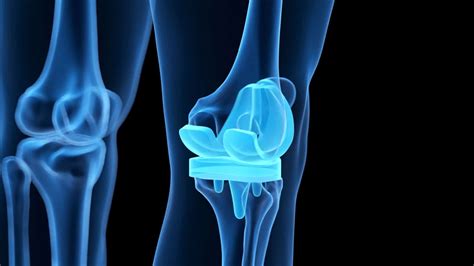 knee near sausalito|Knee Resurfacing near Sausalito, CA .